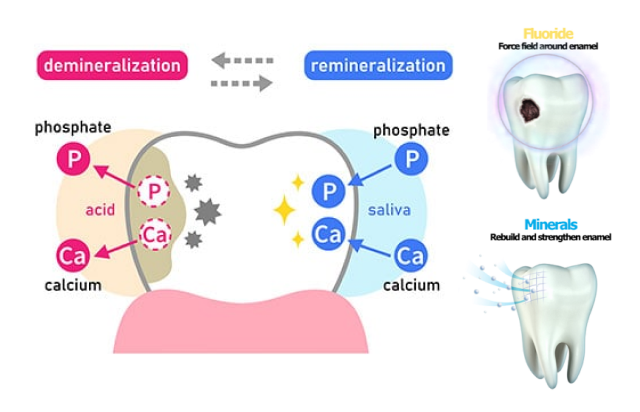 remineralization trays